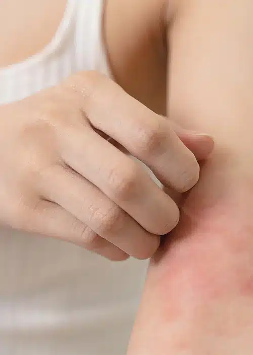A person in a white sleeveless shirt scratches a red, irritated rash on their forearm, suggesting discomfort or itchiness from a skin condition such as eczema or an allergic reaction. The background is out of focus.